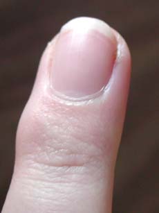 My finger as of Tuesday morning.